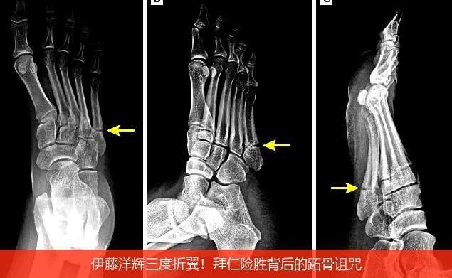 伊藤洋辉三度折翼!拜仁险胜背后的跖骨诅咒